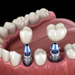 Periodoncia e Implantes Dentales en G. Zubillaga, Donostia / San Sebastián