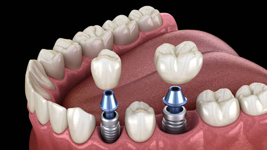 Periodoncia e Implantes Dentales en Donostia