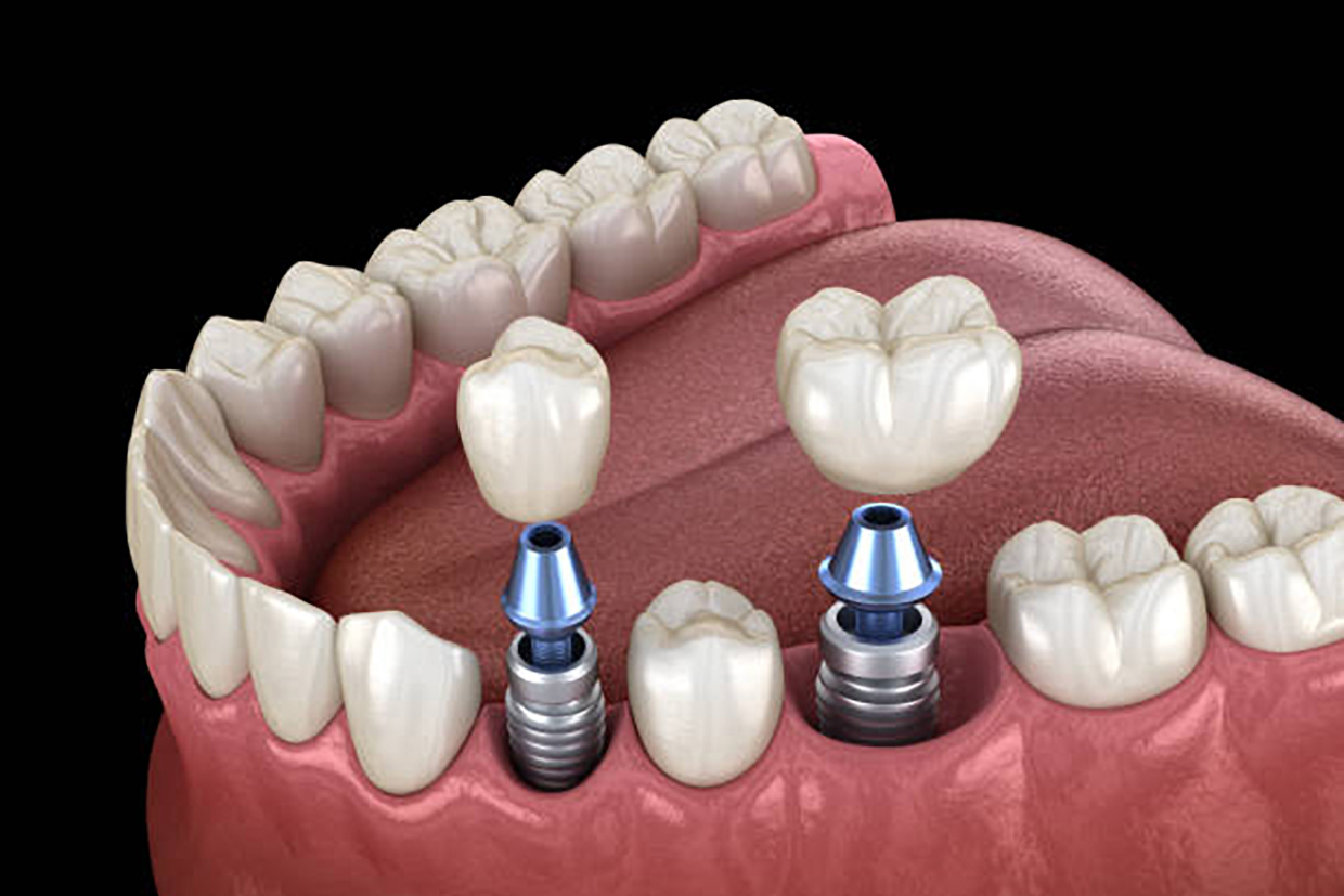 Periodoncia e Implantes Dentales en Donostia